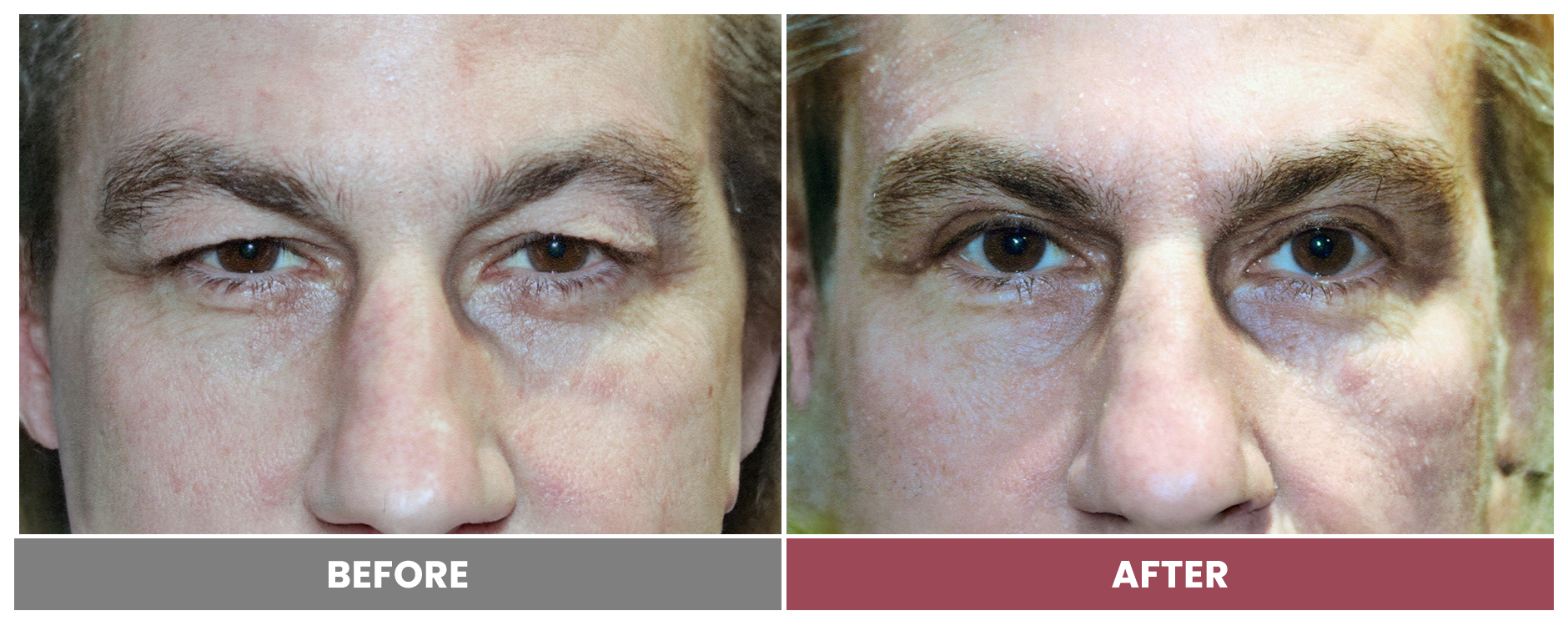 Upper Blepharoplasty - Case 82